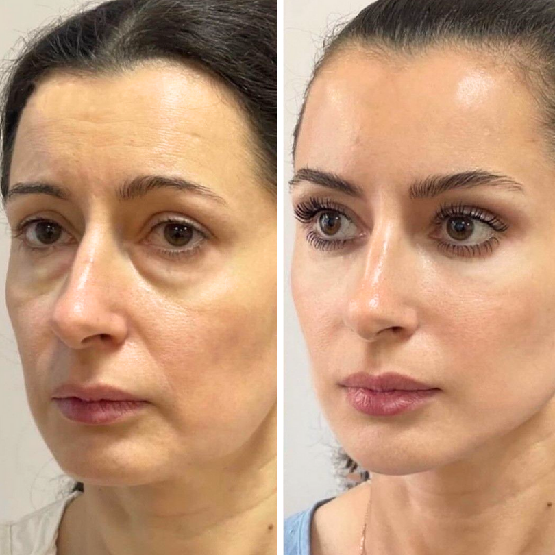 Biancat® LiftRenew All-in-One Under-Eye Stick