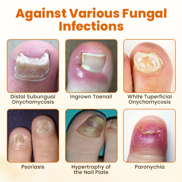 Timilk® FungiBee Advanced Nail Repair Spray⚕️