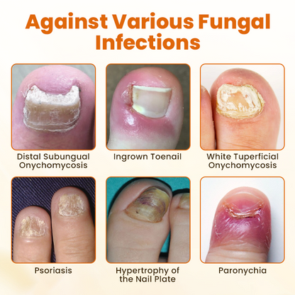 Timilk® FungiBee Advanced Nail Repair Spray⚕️