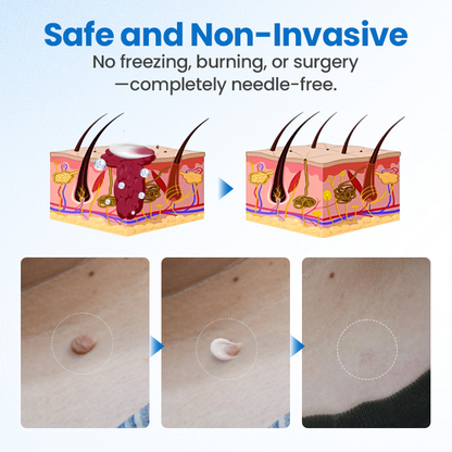 Timilk® TagGone Wart Removal Cream ✨